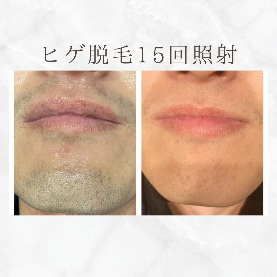 画像8435：BEFORE AFTER